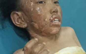 Perjuangan Rinda: Bocah Korban Kebakaran Barongan, Bertahan di Tengah Derita dan Harapan