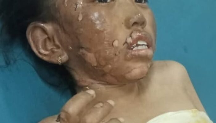 Perjuangan Rinda: Bocah Korban Kebakaran Barongan, Bertahan di Tengah Derita dan Harapan